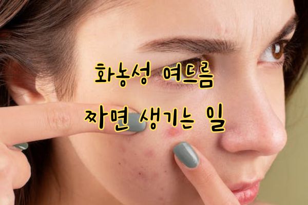 화농성 여드름 관리 방법 화농성 여드름 관리 방법