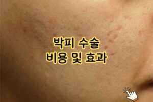 박피 수술 비용 및 효과 박피 수술 비용 및 효과