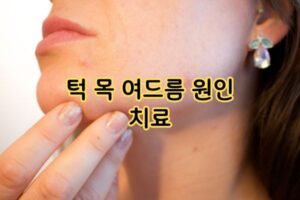 턱 여드름 원인 치료 턱 여드름 원인 치료