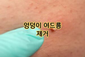 엉덩이 여드름 제거 방법 엉덩이 여드름 제거 방법