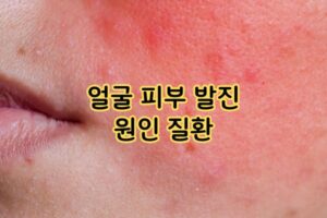 얼굴 피부 발진 원인 질환 얼굴 피부 발진 원인 질환