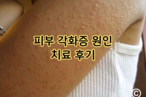피부 각화증 원인 치료 후기 피부 각화증 원인 치료 후기