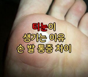 티눈 생기는 이유 손 발 통증 차이